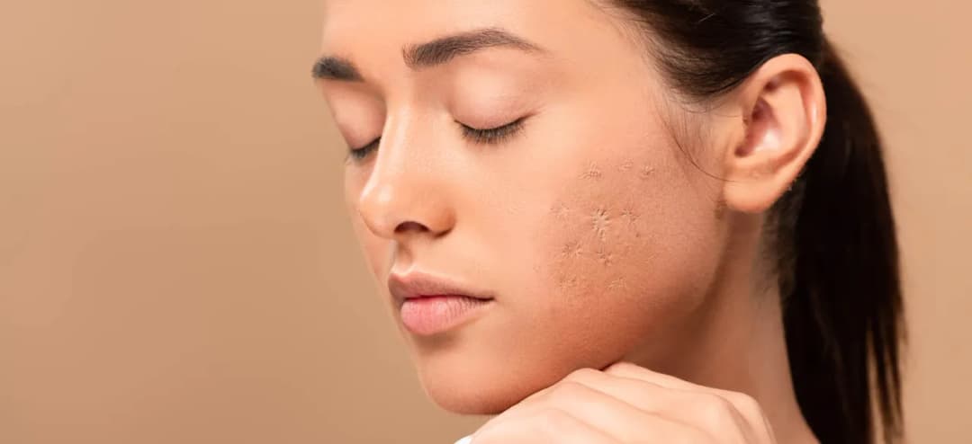 Skuteczne sposoby na blizny po ospie dla dziecka - co warto wiedzieć